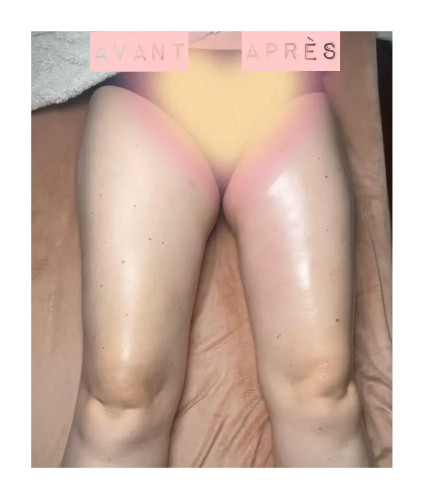 Drainage anti-cellulite à Mont-sur-Meurthe